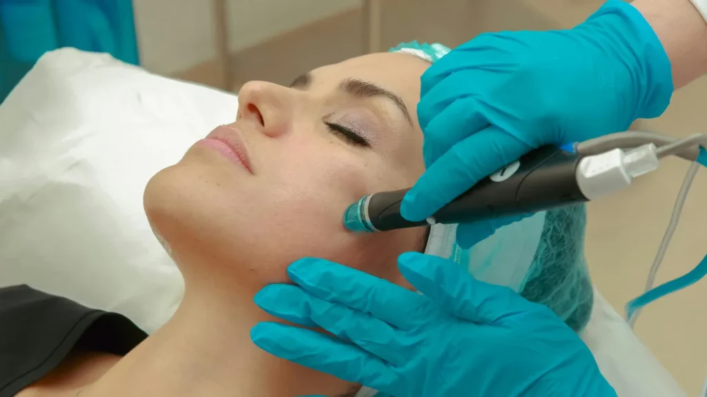 Microagulhamento facial